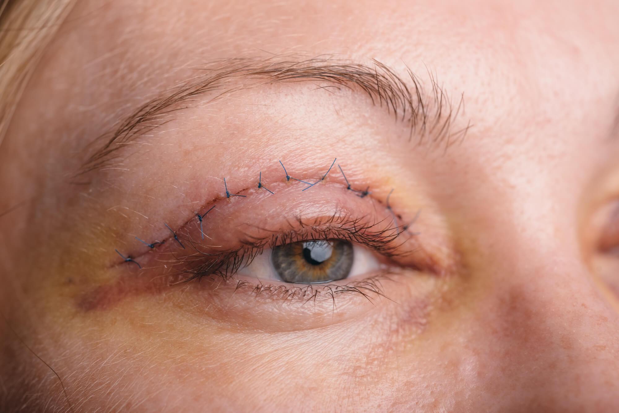 جراحی چشم در کلینیک های زیبایی 